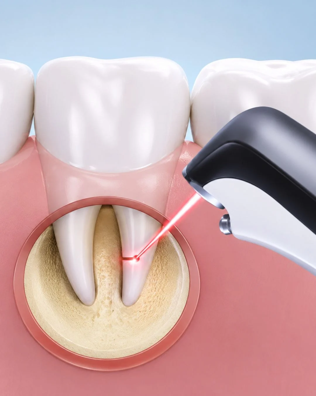 Illustration of an instrument directed at the exposed root tip of a tooth within the surrounding bone