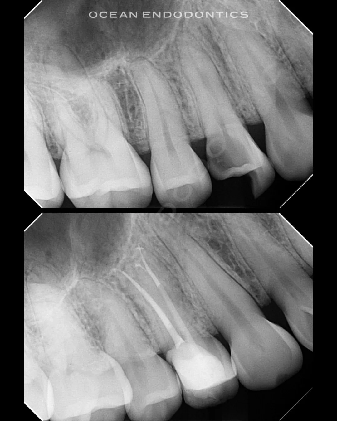 Periapical radiographs of an upper molar from a cracked tooth case at Ocean Endodontics