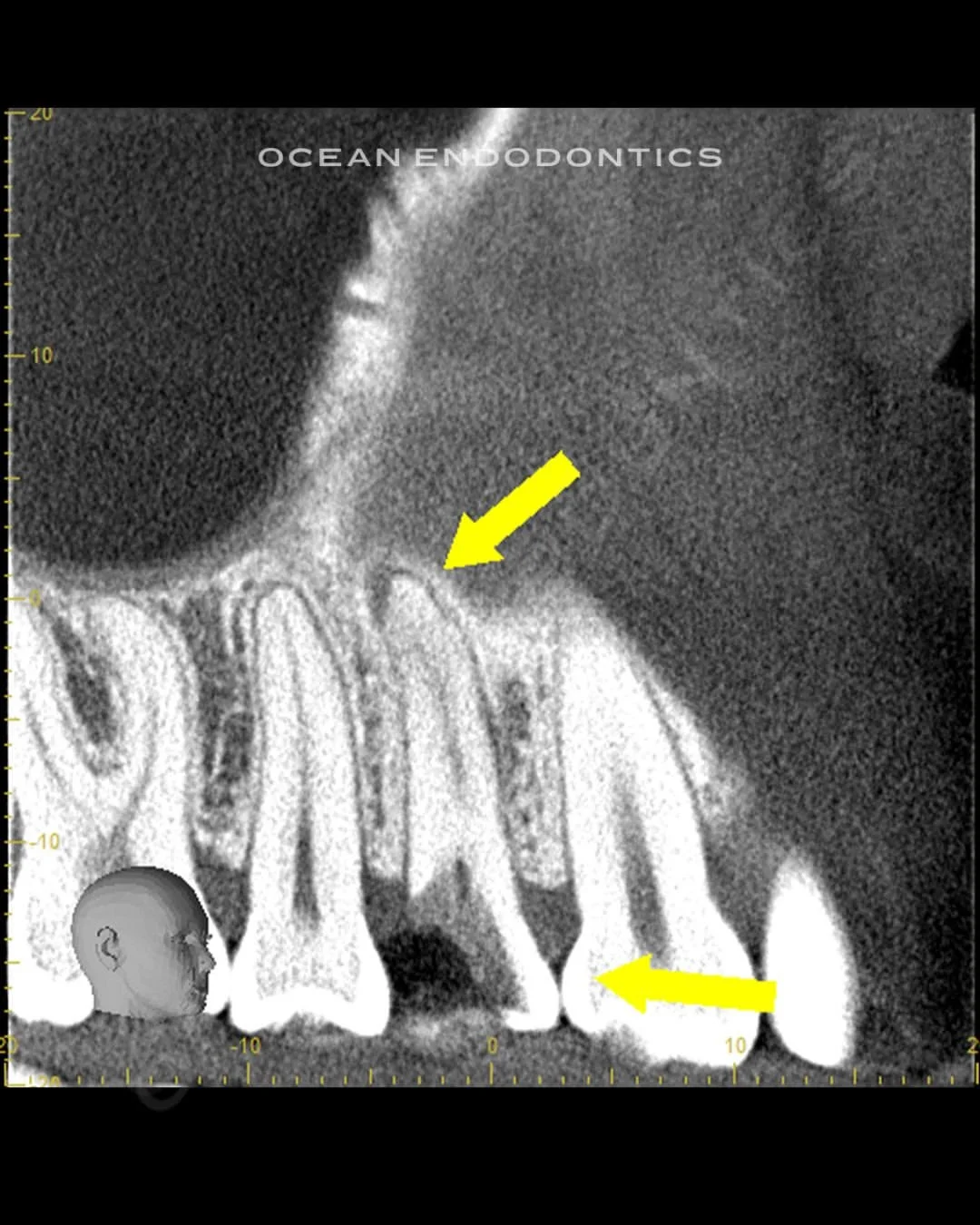 Cone beam 3D image with arrows marking bone changes around a cracked upper tooth