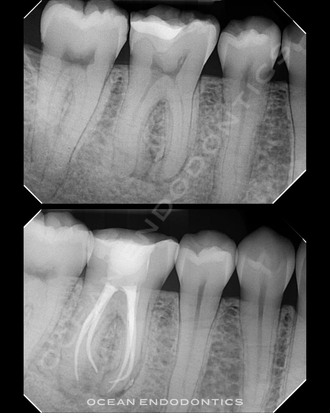 Periapical radiographs of a lower molar before and after emergency root canal treatment at Ocean Endodontics