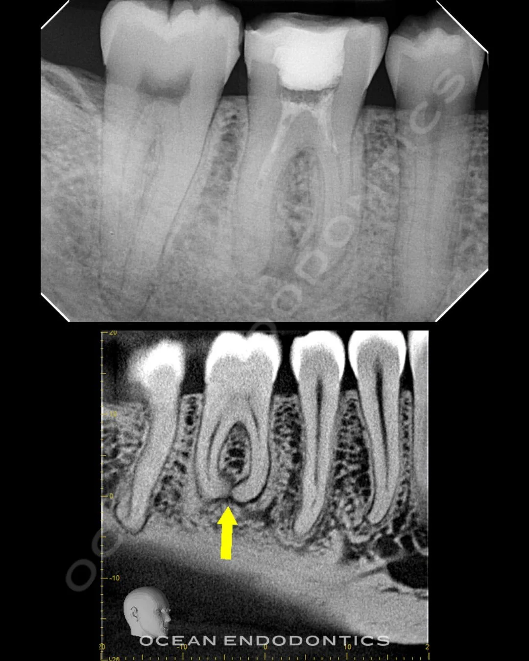 Periapical radiograph and cone beam 3D image from an emergency case, with an arrow marking the affected root