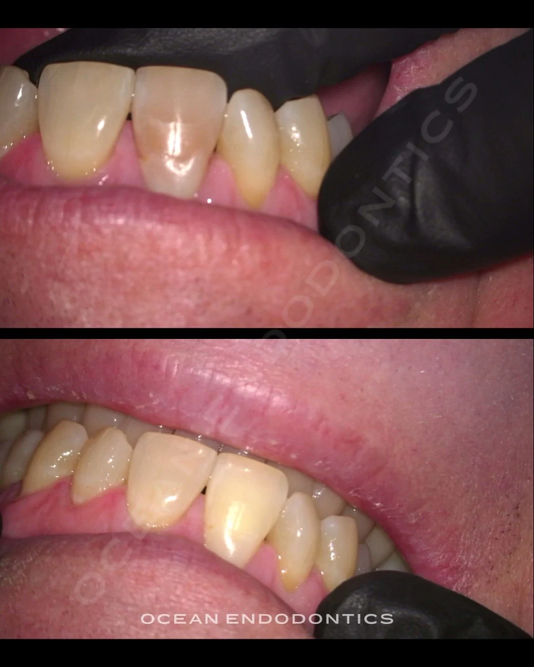 Intraoral photographs of a darkened front tooth before and after internal bleaching at Ocean Endodontics