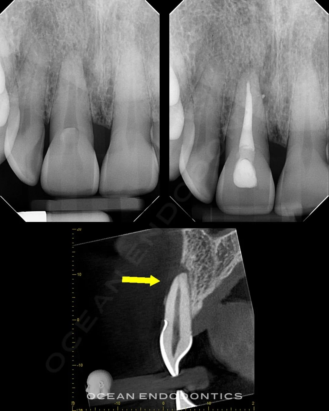 Periapical radiographs and a cone beam 3D image of the treated front tooth from the same internal bleaching case