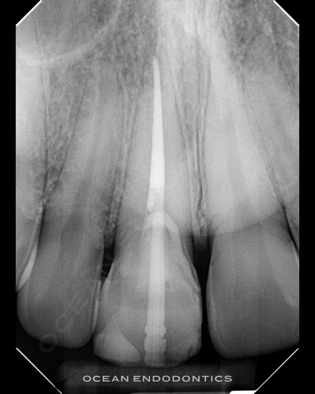 Periapical radiograph of an upper front tooth restored with a post and core at Ocean Endodontics