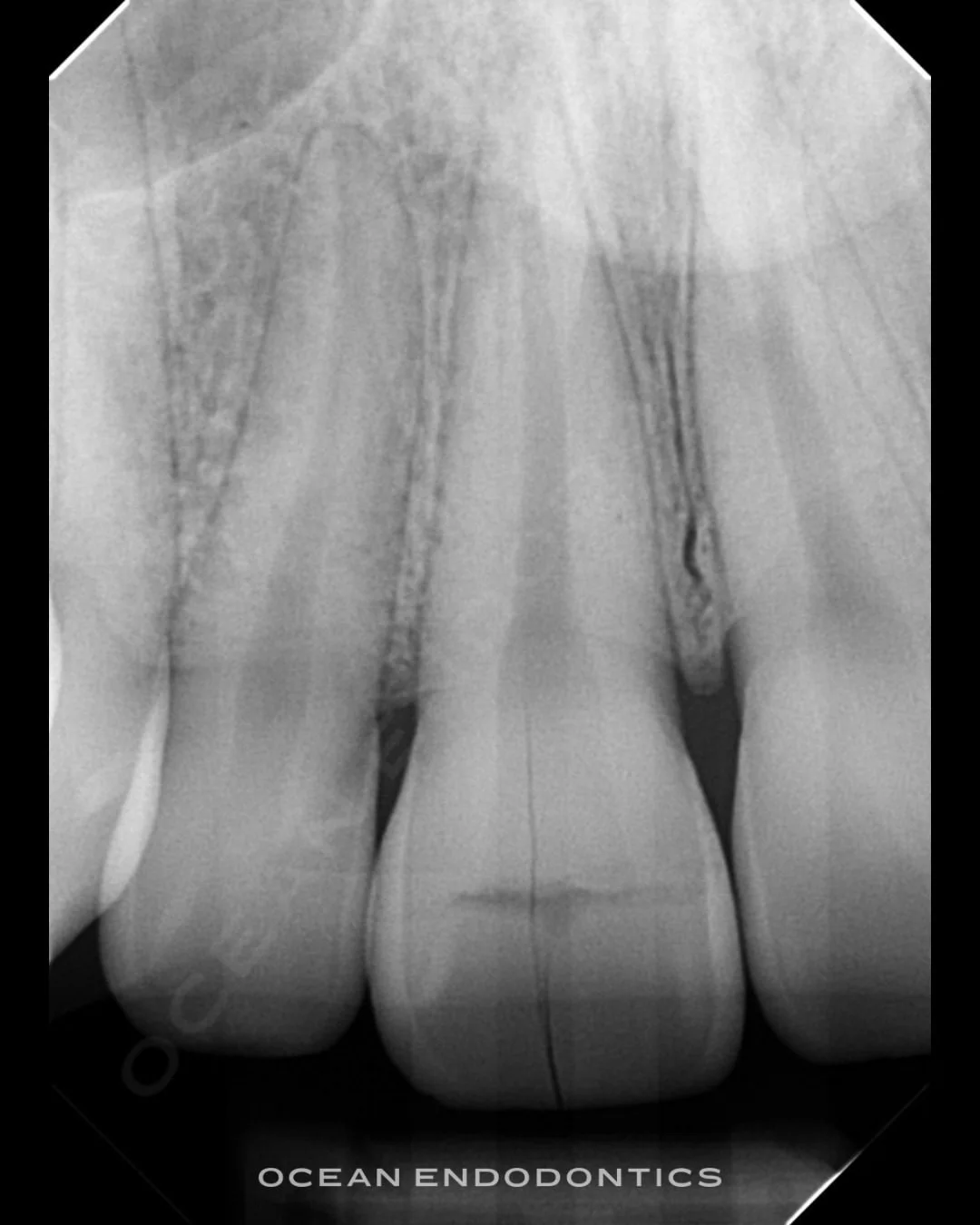 Periapical radiograph of upper front teeth from a post and core case at Ocean Endodontics