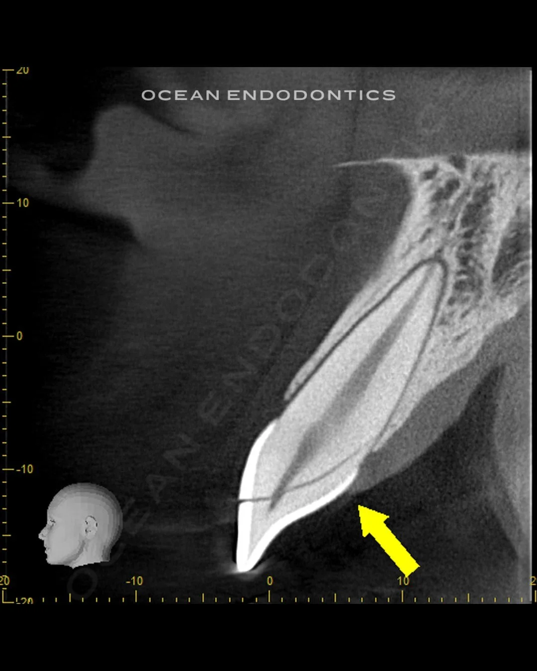 Cone beam 3D image of an upper front tooth, with an arrow marking the root anatomy