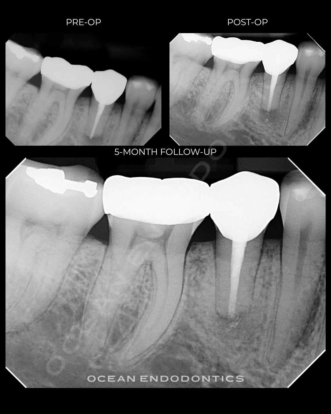 Radiographs from a retreatment case at Ocean Endodontics, labelled pre-op, post-op, and five-month follow-up