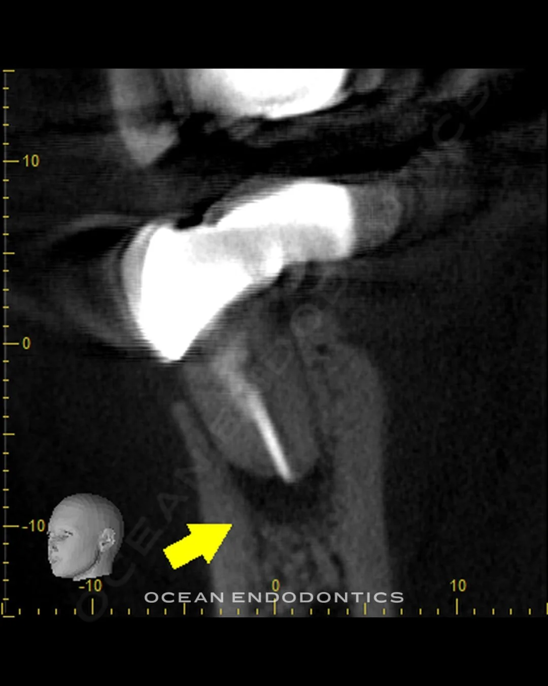 Cone beam 3D image from a retreatment case, with an arrow marking the area of concern at the root
