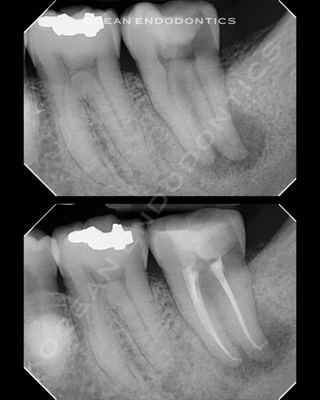 Periapical radiographs from a root canal case treated at Ocean Endodontics, showing the tooth before treatment and with the canal system sealed afterward