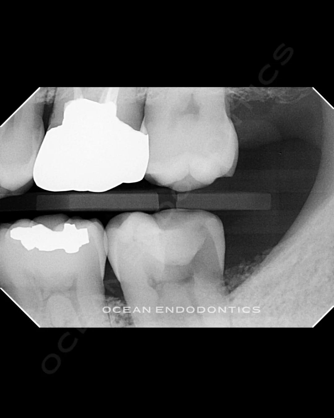 Periapical radiographs of a lower molar from a root canal case treated at Ocean Endodontics