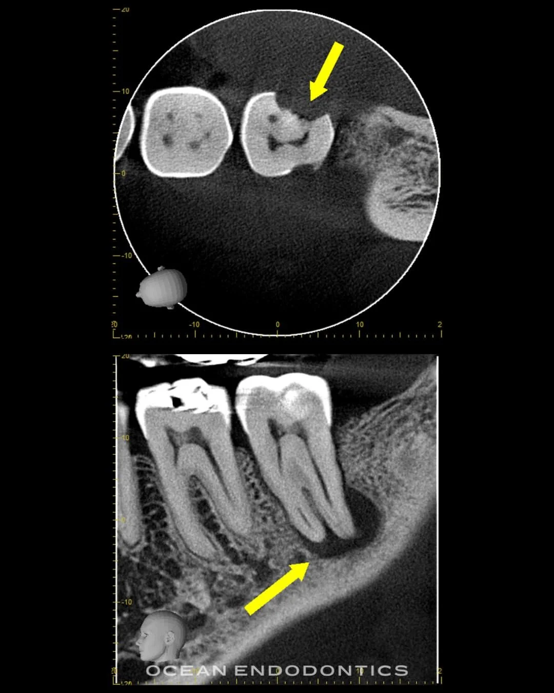 Cone beam 3D imaging of a molar, with arrows marking canal anatomy identified before treatment